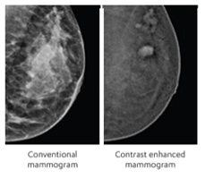 Contrast enhanced mammogram