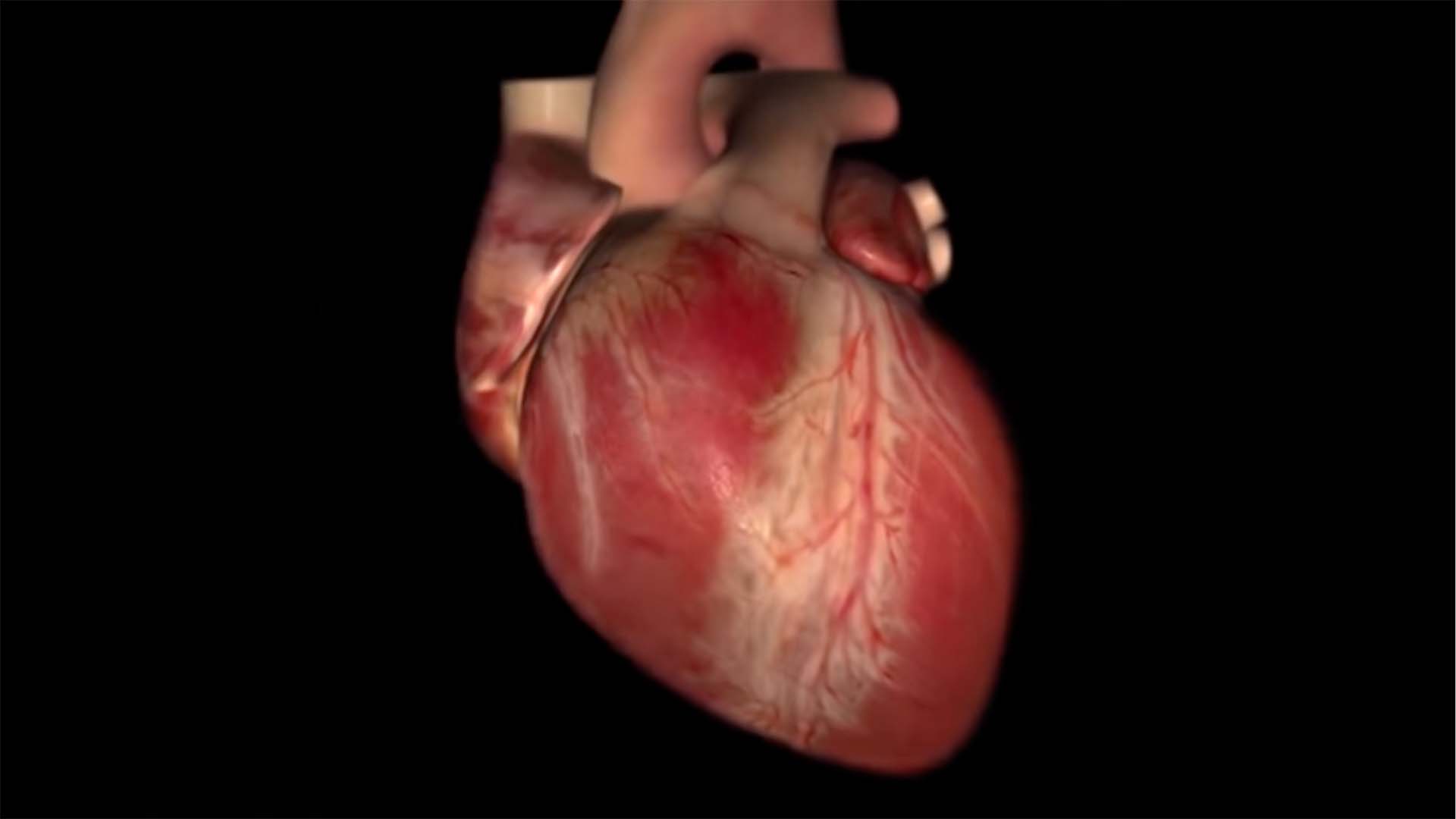 Cardiac angiogram video
